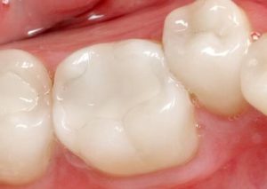 Сколько стоит установка пломбы на зуб и куда обратиться лучше